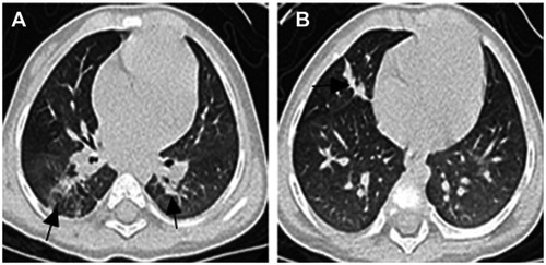 Figure 2 Chest HRCT scan after 12 months of antibiotic therapy. (A and B) Most of the lung lesions are absorbed, but there were still some strip shadows in both lungs (arrows).Abbreviation: HRCT, high-resolution computed tomography.
