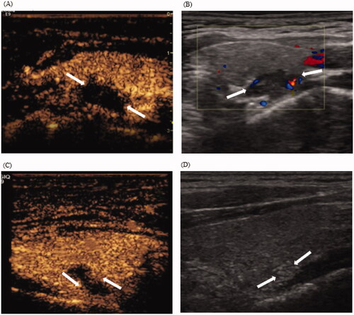 Figure 3. CEUS displaying incomplete ablation in a 46-year-old woman with pHPT. (A) CEUS images immediately after MWA: non-enhancement area covers the pHPT nodule (arrows). (B) Color Doppler images 1 day after MWA: signs of punctate blood flow signals of the margin of the ablation zone (arrows). (C) CEUS images 1 day after MWA: the arterial phase demonstrates an annular enhancement area (arrows) around the ablation zone. (D) US images 1 year after ablation: the VRR of the ablation zone (arrows) is 83.6% ablation zone (arrows). CEUS: contrasted-enhanced ultrasound; pHPT: primary hyperparathyroidism; MWA: microwave ablation; VRR: volume reduction rate; US: ultrasound.