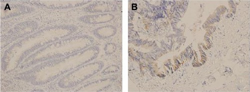Figure 2 Expression of MUC1 in nontumor tissue adjacent to carcinoma (A) and colorectal cancer (B).