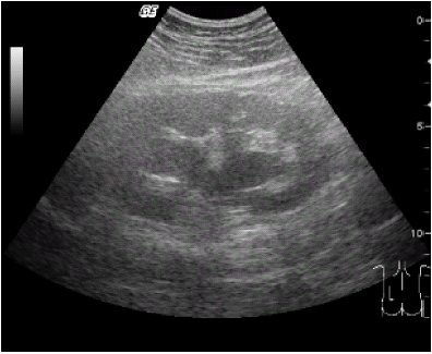 Figure 2a. Renal echo showed moderate hydronephrosis of left kidney pre-operation.