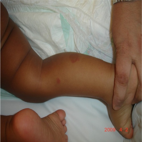 Figure 2 Oval, purpuric, and targetoid lesion on the right lower extremity.