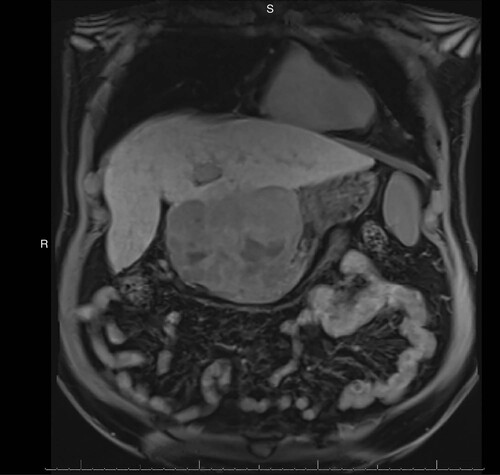 Figure 1. Coronal MRI demonstrating the large heterogeneous exophytic hepatic mass.MRI: Magnetic resonance imaging.