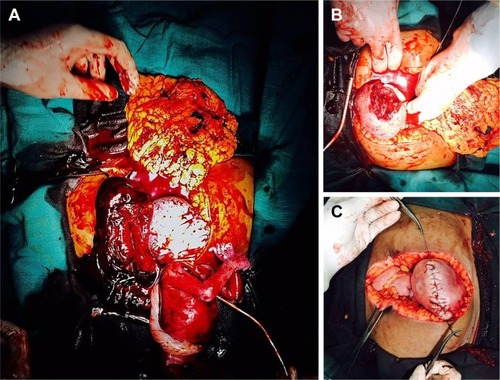 Figure 2 An intraoperative image of uterine rupture at 23 weeks of gestation in a primigravida, showing the fetus lying outside the uterus (A). The rupture at the fundus is clearly seen (B). Repair of the uterus in two layers with absorbable sutures (C).