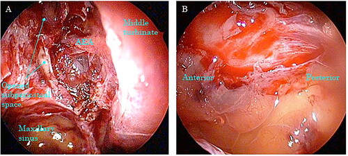 Figure 2. Intraoperative endoscopic findings of the right middle meatus. The orbital lamina is resected and the subperiosteal abscess is drained. The AEA is preserved. AEA: anterior ethmoidal artery.