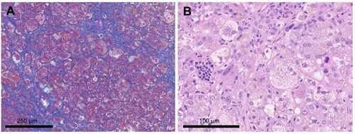 Figure 2 . Histopathological examination of the liver biopsy specimen. (A) Azan staining reveals liver cord atrophy with fibrosis around individual hepatocytes, indicating severe hepatic fibrosis. (B) Hematoxylin and eosin staining shows erythroblastic islands and sporadic megakaryocytes in the liver tissue.