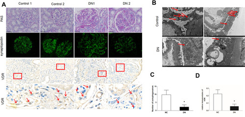 Figure 1 The expression of VDR protein and autophagosomes are decreased in podocytes of diabetic patients. Kidney biopsy specimens were from patients with diabetic nephropathy (DN) and non-tumor renal tissue from patients with kidney cancer. (A) Representative pictures of periodic acid-Schiff (PAS) staining, anti-synaptopodin immunofluorescence (IF) and VDR immunohistochemistry (IHC). Bottom panels are enlarged images of the boxed areas in the middle panels. Arrows indicate VDR was mainly expressed in glomerular podocytes with nuclear staining. (B) Representative ultrastructural imagines showing autophagosomes in podocytes. Arrows indicate autophagosomes in podocytes. (C) Semi-quantitative measurement of VDR intensity in the glomeruli in each group. (D) Quantification of autophagosomes in podocytes. All results are presented as mean ± SEM, *P<0.05 considered statistically significant.