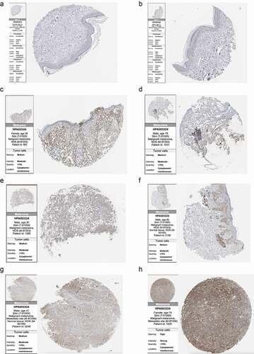 Figure 9. Immunohistochemistry sections of normal skin tissues and melanomas in Human Protein Atlas: (a, b) Immunohistochemistry of two normal skin tissues showed that SLC16A1 was almost undetectable in normal skin tissues. (c-f) Immunohistochemistry sections of four primary melanoma patients showed moderate staining of SLC16A1 in the primary melanoma. (g, h) Immunohistochemistry sections of two patients with metastatic melanoma. Figure H shows the strong staining of SLC16A1 in metastatic melanoma