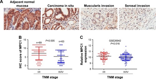 Figure 2 MPC1 expression was closely correlated with TNM stage in patients with GC.