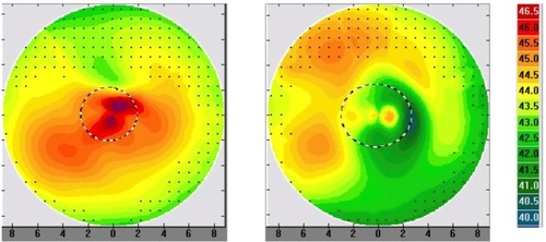 Figure 1 Placido disc topography for patient 3 preoperatively (left) and 6 months postoperatively (right) depicting the significant and regular central corneal flattening effect.