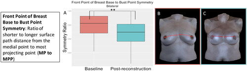 Figure 17. The front point of breast base to bust point symmetry significantly decreased (became more asymmetrical) for the participants who underwent bilateral implant-based reconstruction (p = 0.01). (A) Boxplot (median and interquartile range) of symmetry at baseline and post-reconstruction. (B) The front point of breast base to bust point measurement on an exemplar patient. (C) The front point of breast base to bust point measurement on the same patient post-reconstruction.