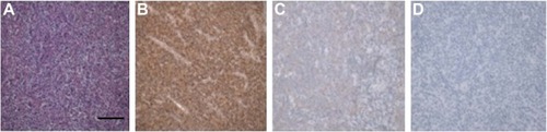 Figure 1 Immunohistochemistry detects HDAC6 in DLBCL patient.