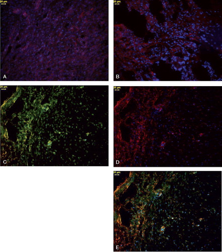 Figure 3. Immunohistochemistry of fibrous callus linking fracture ends in a rat rib fracture after 7 days. Panels C–E show immunostaining of the same callus section. Cell nuclei for panels A–E were stained with DAPI (blue).A.Osteoprogenitor cells show consistent but moderate CaP-LI (indicated by red fluorescence).B.There is intense EDA-fibronectin-like immunoreactivity (LI) (indicated by red fluorescence) in some regions of callus; other areas show only moderate EDA-fibronectin-LI immunostaining.C.OB-cadherin-LI in osteoprogenitor cells (indicated by yellow-green fluorescence). OB-cadherin-LI is particularly intense in high-density fibrous regions (left of picture). Not all cells are OB-cadherin-positive, however.D.Osteoprogenitor cells to the left contain significant αSMA-LI (indicated by red fluorescence), but the cells to the right show only moderate αSMA-LI.E.A sequentially immunostained section for αSMA (red fluorescence) and OB-cadherin (yellow-green fluorescence). Co-localization of these two proteins by immunohistochemistry resulted in a combined brown-orange fluorescence, which is mainly located in osteoprogenitor cells to the left of this micrograph. Note that some cells only show either αSMA-LI or OB-cadherin-LI. Magnification: ×200; scale bars = 20 μm.
