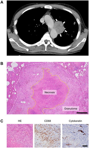 Figure 1. Clinical and pathological images of the lung. (A) Computed tomography image showing a low-intensity lesion measuring approximately 6 cm in the left pulmonary hilum (arrows). (B) Low-power field image of a resected lung specimen with hematoxylin and eosin (HE) staining. The necrotic tissue is within the yellow dotted line. The granulomatous lesion around the necrotic tissue is located between the white and yellow dotted lines. Bar, 500 μm. (C) High-power field image of the granulomatous lesion. Spindle cells are positive for CD68, a histiocytic marker, while cytokeratin, an epithelial marker, is expressed by the remaining lung tissue. Bar, 100 μm.