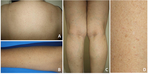 Figure 2 Clinical presentations: multiple discrete comedone-like hyperkeratotic brownish papules distributed symmetrically on the trunk (A) and extremities (B and C); close-up image of the lesions (D).