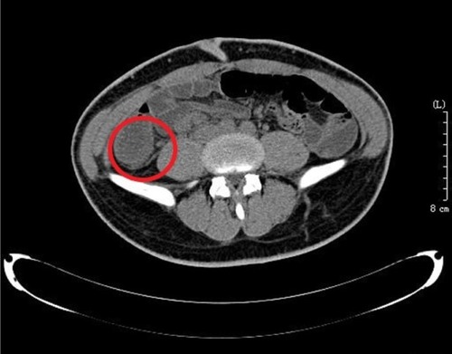 Figure 1 Abdominal CT showing the gas-liquid levels and dilatation of the intestinal tract and an obscured appendiceal area revealing edema of this area (circle).