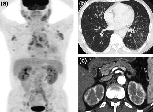 Figure 1. Diagnostic imaging shows multiple organ involvement. (a) Positive emission tomography shows accumulation of fluorodeoxyglucose in the parotid and submandibular glands, lymph nodes, lungs, pancreas, kidneys, and prostate. (b)–(c) Enhanced CT showed submandibular, supraclavicular, axillary, mediastinal, paraaortic, and inguinal lymph node swelling, interstitial pneumonia with small nodular lesions and bronchiectasis in the lung, patchy hypoattenuated lesions in the pancreas head and body, multiple low-density lesions in the kidney, and abdominal aortic aneurysm with aortic wall thickening.