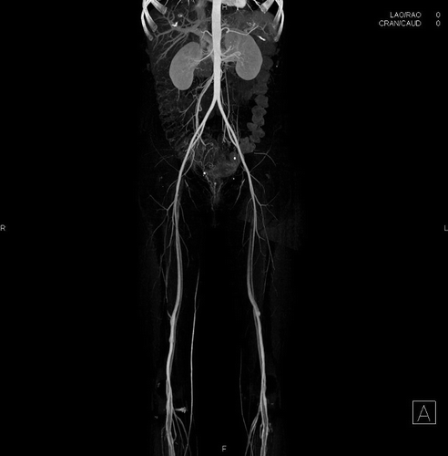 Figure 1. CT angiography on hospital day 6 (four days after her first symptoms and three days after her first unobtainable blood pressure). Findings included “marked vasoconstriction of the superficial femoral, popliteal, and tibial arteries” with “vasospasm involving the distal branches of the superior mesenteric artery.”