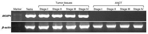 Figure 1.AKAP4 expression in representative Stage I, Stage II, Stage III and Stage IV ovarian cancer tissue specimens. Tissue samples were analyzed by RT-PCR with AKAP4-specific primers. No AKAP4 expression was detected in matched adjacent non-cancerous tissue (ANCT) specimens. Testis cDNA was used as a positive control, while β actin was quantified as an internal loading control.