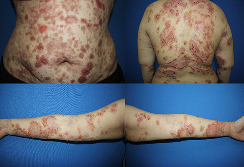 Figure 1 A 21-year-old female diagnosed with severe BSLE and autoimmune hemolytic anemia. Multiple tense bullae on erythematous base at trunk and extremities.