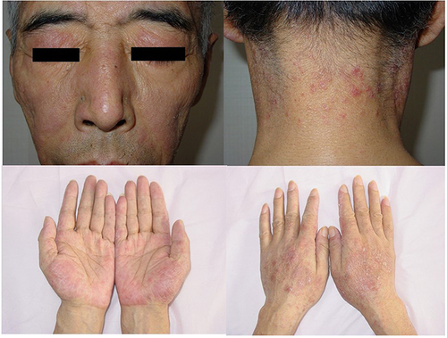 Figure 1 Clinical presentation of the patient: multiple erythematous papules and plaques symmetrically distributed in both upper eyelids, cheeks, dorsal and palms of both hands, and the posterior neck; there were a few white scales on the surface of the lesions.
