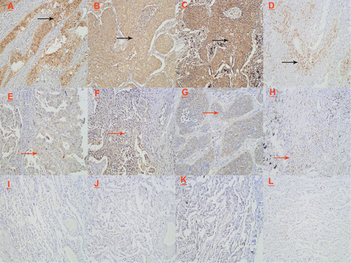 Figure 1 (A–C) represent the high expression of GSDME, caspase3 and HMGB1 proteins in lung cancer tissues, respectively. (D) The expression of high abundance of CD8+T lymphocytes in lung cancer tissues. (E–G) are GSDME, caspase3, HMGB1 protein in lung cancer tissue low expression. (H) Low abundance of CD8+T lymphocytes in lung cancer tissues. (I–L) is the distribution of GSDME, caspase3, HMGB1, and CD8+T lymphocytes in paracancerous tissues. In the figure, the black arrows is a high expression image and the red arrows is a low expression image. (Images were acquired at 200 × magnification.).
