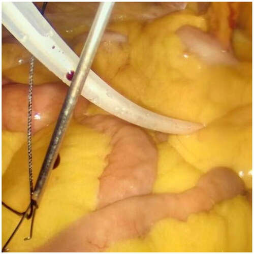 Figure 3. Ssuture passer was retrieve the suture contralaterally (The left side is the head).