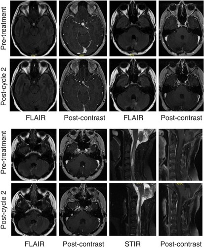 Figure 1. Pre- and post-treatment MRI brain and cervical spine for patient 1. Interval MRI of the brain and cervical spine performed with and without intravenous gadolinium contrast reveals a decrease in the degree of enhancement of intracranial lesions (pituitary area, multiple posterior fossa lesions, cervical lesion) and reduced perilesional FLAIR and STIR signal intensity. T1 postcontrast images of the cervical spine are fat suppressed.FLAIR: Fluid-attenuated inversion recovery; STIR: Short-TI inversion recovery.