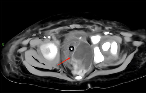 Figure 5 MRI shows a solid mass on the left side of the pelvis, as the red arrow shows.