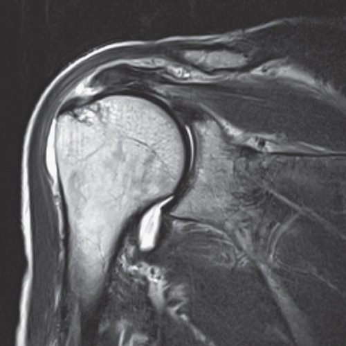 Figure 4. Case presentation. Magnetic resonance image (T2WI) of a shoulder showing rotator cuff tear and glenohumeral effusion.