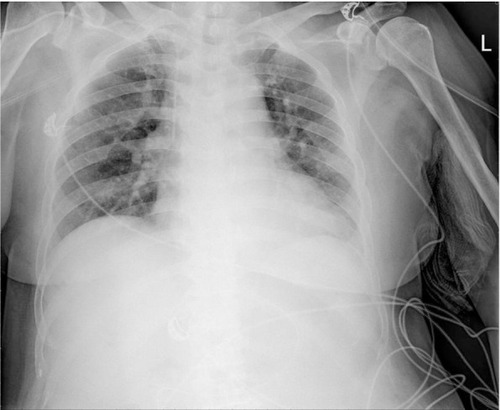 Figure 3 Plain chest X-ray at the third postoperative day showed the resolution of pulmonary edema.