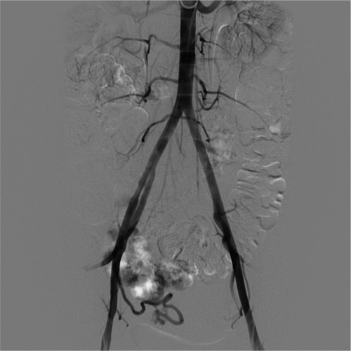 Figure 5 Pelvic angiogram shows the nidus totally embolized by Onyx.