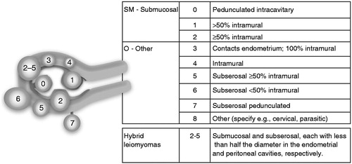 Figure 2. Uterine fibroid subclassification within the FIGO abnormal uterine bleeding classification system. Intracavitary lesions are attached to the endometrium by a narrow stalk and are classified as Type 0, whereas Types 1 and 2 require a portion of the lesion to be intramural – with Type 1 having less than 50% involvement and Type 2 at least 50%. Type 3 lesions are totally extracavitary but abut the endometrium. Type 4 lesions are intramural UFs that are entirely within the myometrium, with no extension to the endometrial surface or to the serosa. Subserosal (Types 5–7) UFs represent the mirror image of the submucosal UFs – with Type 5 being at least 50% intramural, Type 6 less than 50% intramural, and Type 7 attached to the serosa by a stalk. An additional category, Type 8, is reserved for UFs that do not relate to the myometrium at all, and would include cervical lesions, those that exist in the round or broad ligaments without direct attachment to the uterus, and other so-called ‘parasitic’ lesions. Hybrid UFs are transmural and are classified by their relationship to both the endometrial and serosal surfaces. Two numbers are separated by a hyphen (e.g., 2–5); the first refers to the relationship with the endometrium, while the second refers to the relationship with the serosa. Reprinted with permission from Munro et al., 2011Citation31.