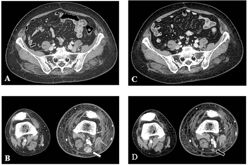 Figure 1 Objective response after CD137 agonist treatment. A baseline CT scan (A and B) detected left external iliac (A; white star) and popliteal metastatic lymph nodes (B; white arrow), which completely disappeared (C, black star; D, black arrow) after 6 months from the last dose of therapy.