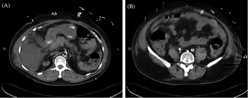Figure 2. Non-contrast abdominal CT scan. (A) Acute pancreatitis (not hemorrhagic), which was evidenced by increased infiltration around the pancreas with minimal peripancreatic infiltration but without a hyperdense lesion. (B) Left psoas muscle hemorrhage diagnosed by swelling of the left psoas muscle with mixed hyperdense and hypodense cystic foci.