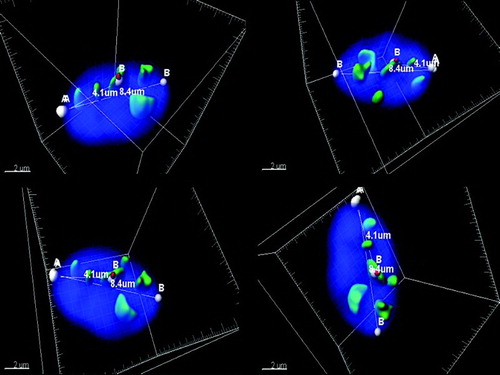 Figure 1.  Three-dimensional (3D) imaging of spermatozoon.Four different angles of a representative spermatozoon nucleus. For each cell, the following was measured: 1) the volume of the nucleus, 2) the volume of pan-centromeric signals, 3) the volume of the chromosome 17 centromere specific signal, 4) the number of observed chromocenter(s) (6 chromocenters for the depicted cell), 5) the distance from the tail attachment (reference point A) to the centromere signal (4.1 µm for the depicted cell), and 6) the long axis (8.4µm), (distance point from A to point B). Fluorescence in situ hybridization (FISH) probes: human chromosome pan-centromeric – green; α-satellite centromere specific chromosome 17 - red. Measurements from the tail attachment point to the centromere of chromosome 17.