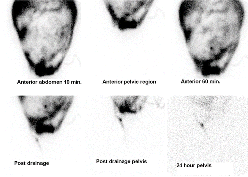 Figure 3 Patient referred with right genital edema. Post-drainage and delayed images of lower abdomen show increased linear activity in right inguinal canal.