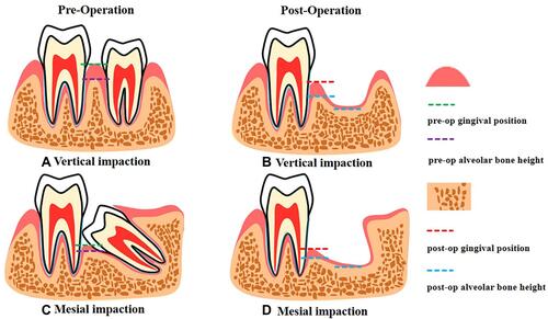 Figure 1 Pre- and post-operative soft and hard tissue comparison of vertical and mesial impacted lower third molar extraction: (A) pre-operation vertical impaction, (B)post-operation vertical impaction, (C) pre-operation mesial impaction, (D) post-operation mesial impacton.