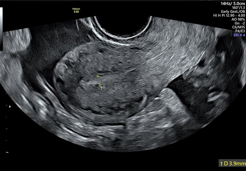 Figure 5. An empty uterus with no obvious intrauterine pregnancy. Endometrial thickness of 3.9 mm.