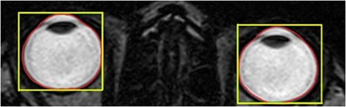 Figure 1 Yellow rectangle- Initial selection of both eyeballs on axial view; Red line- Defining the outline of the selected eyeball shape.