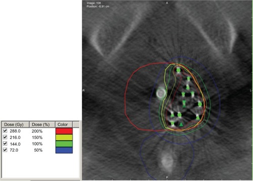 Figure 1 Hemigland brachytherapy implant.Note: Computed tomography (contours of the prostate in red, target in yellow, rectum in blue. 100%, 150%, and 200% isodose lines in green, yellow, and red). The green triangles and circles indicate seed positions.