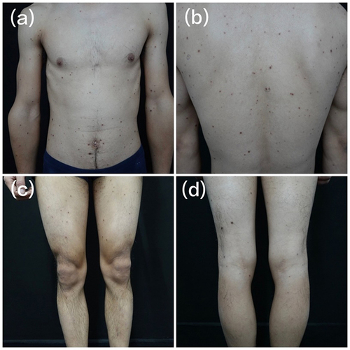 Figure 1 Clinical manifestation. Dark brownish red maculopapules were distributed on the trunk and extremities. (a) front of trunk, (b) dorsal side f trunk, (c) extensor side of lower limbs, (d) flexor side of lower limbs.