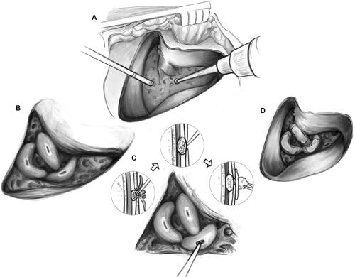 Figure 1. Surgical procedures of TSCP.