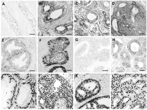 Figure 1. TGF-β (A, B), TGFBRI (C, D), TGFBRII (E, F), PI3K (G, H), p-AKT-Ser (I, J) and p-AKT- Thr (K, L) in normal prostate (A, E, G) and prostate cancer (B, C, D, F, J, K, L). Scale bars: 25 μm (B, C, D, E, F, I, J, K, L), 20 μm (G, H), and 15 μm (A).