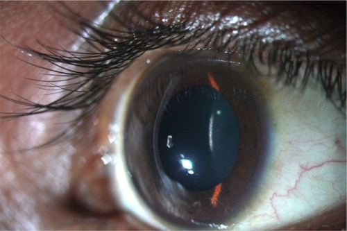 Figure 1 Slit-lamp photograph of an eye with keratoconus demonstrating increased corneal curvature (ectasia).