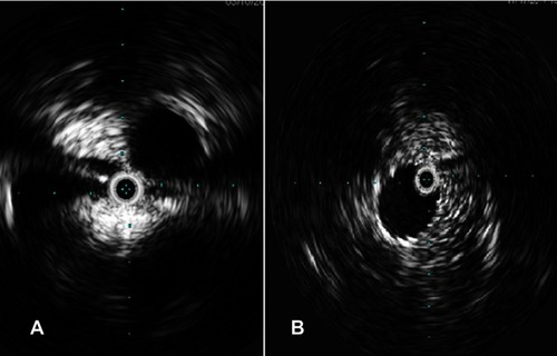 Figure 2 Intravascular ultrasound showing iliac vein compression (pretreatment, A) and post stenting (B).