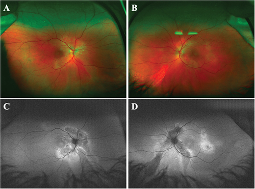 Figure 1. Multimodal imaging on initial presentation of Patient 1. A-B. Ultra wide-field fundus images showed multifocal retinal pigment epithelial detachments (PEDs) with subretinal fluid in macula and tracks of RPE atrophy extending from posterior pole inferiorly and nasally with shallow inferior subretinal fluid in both eyes. C-D. Fundus autofluorescence images revealed multifocal hypoautofluorescent mottled areas around optic nerve and macula with hyperautofluorescent borders, tracking inferonasally from optic nerve area in both eyes.