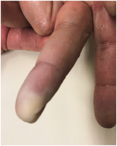 Figure 4. Skin discoloration in the distal third of the right middle finger (volar view).