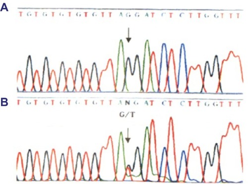 Figure 3 Identification of the c. 1517-I G>T acceptor splicing site mutation on gene C0L4A5.