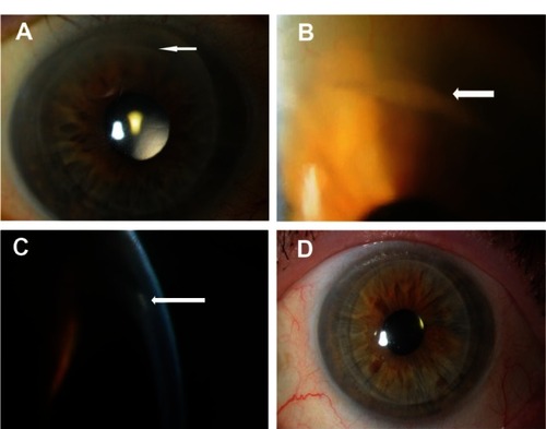 Figure 1 (A) Photograph after Descemet stripping automated endothelial keratoplasty showing a white opacity (arrow) at the interface at the 12 o’clock position away from the temporal host corneal incision site. (B) Magnified view of the area of white opacity (arrow) at the interface. (C) Slit-lamp image showing epithelial ingrowth (arrow) between the graft and the host cornea. (D) Postoperative photograph after repeat Descemet stripping automated endothelial keratoplasty showing a clear cornea.
