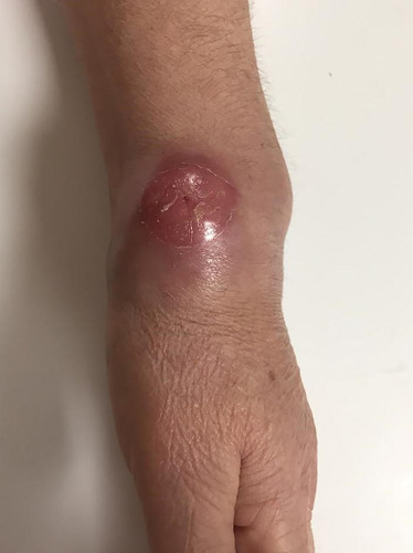 Figure 1 Before antituberculous treatment. Swelling, redness and cutaneous fistulization are shown on the left wrist.